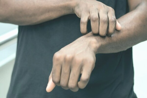 Гомосексуалисты могли распространить оспу обезьян по Европе 