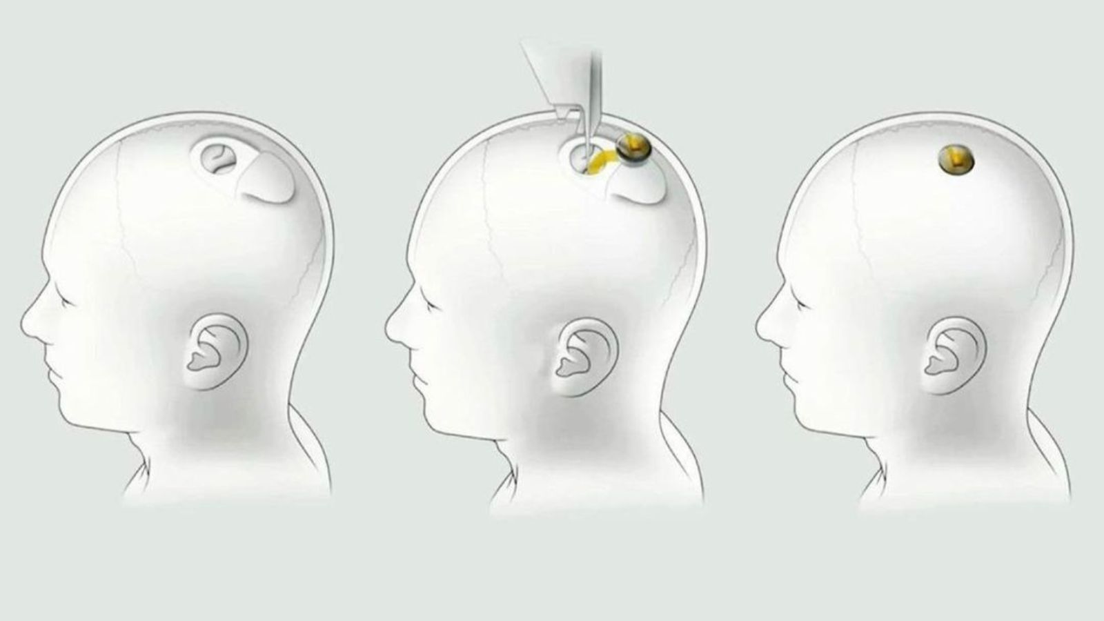 Вперше в історії компанія Ілона Маска Neuralink вживила чіп у мозок людини: навіщо фото 1